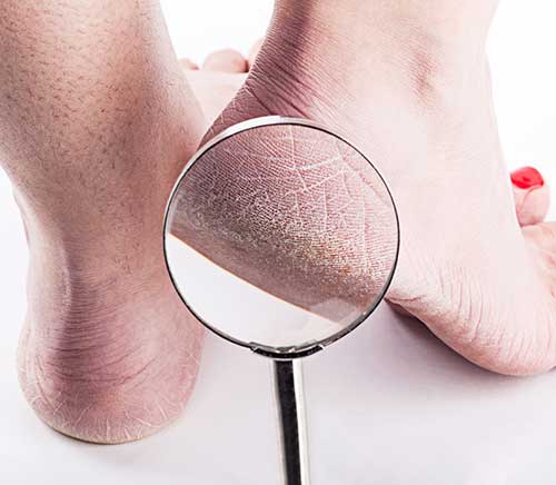 dry cracked heels treatment ashton