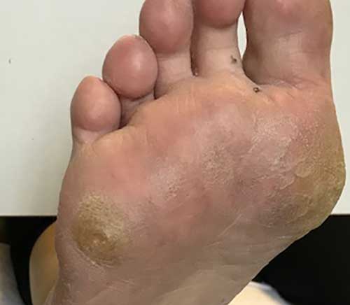 callus treatment ashton